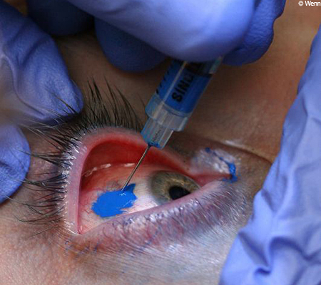 “EYE BALL TATTOOING”. Really how can someone risk their eyes like